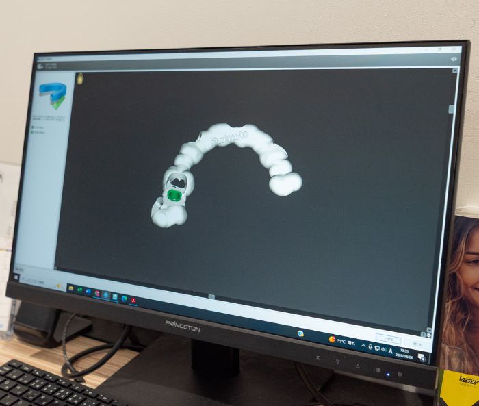 院内3Dプリンターでサージカルガイドを製作